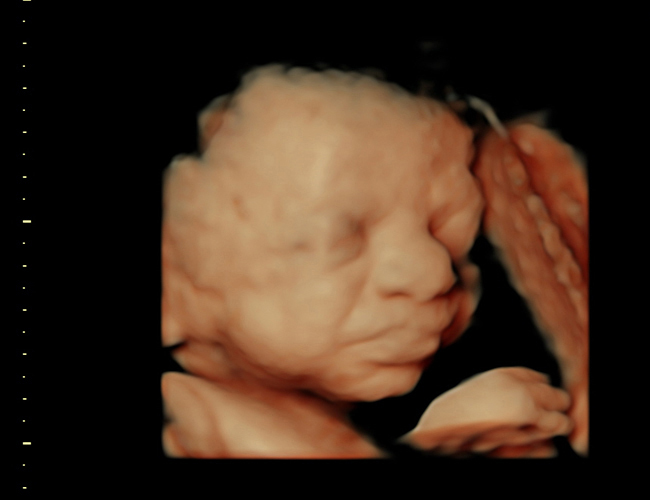 3D ultrasound image at 31 weeks